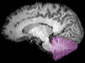 Cerebellum sag