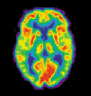 PETscan