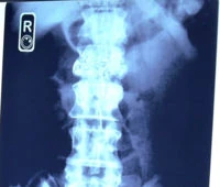 Xray