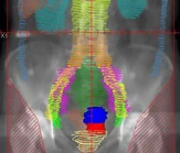 Radiation WholeAbdomen1 cuadrada.jpg