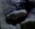 Kessicks finger.jpg