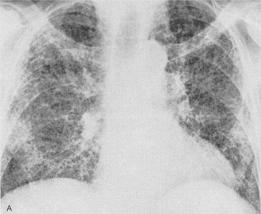 Rx fibrosis pulmonar.jpg