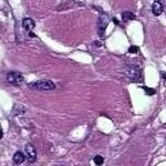 Fetal rhabdomyoma.2