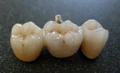 Bridge from dental porcelain.jpg