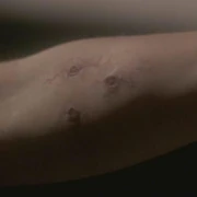 A nesset bite wound.